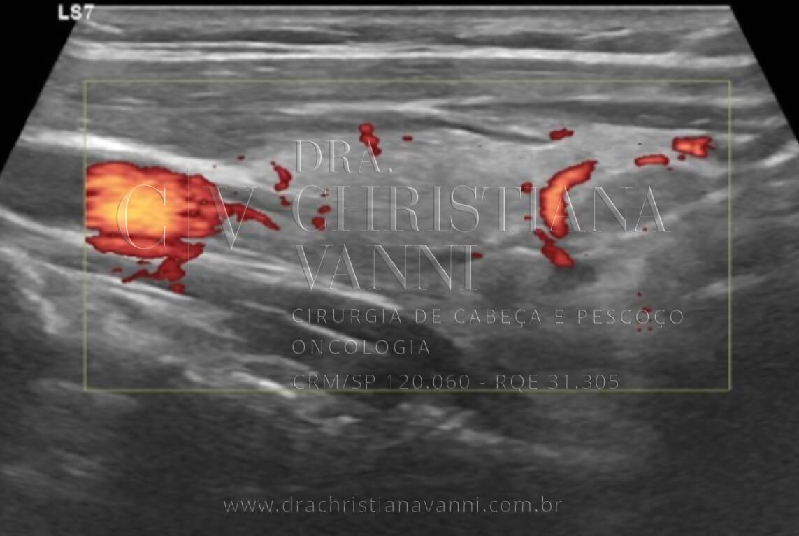 Ultrassonografia de Tireoide TI-RADS 4