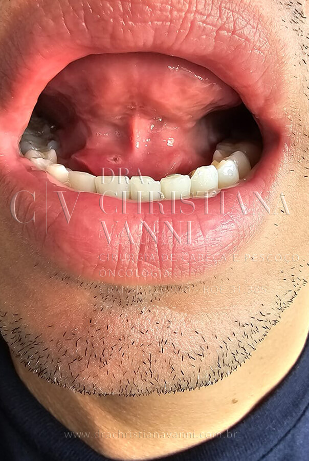 Infecção de glândula submandibular por cálculo