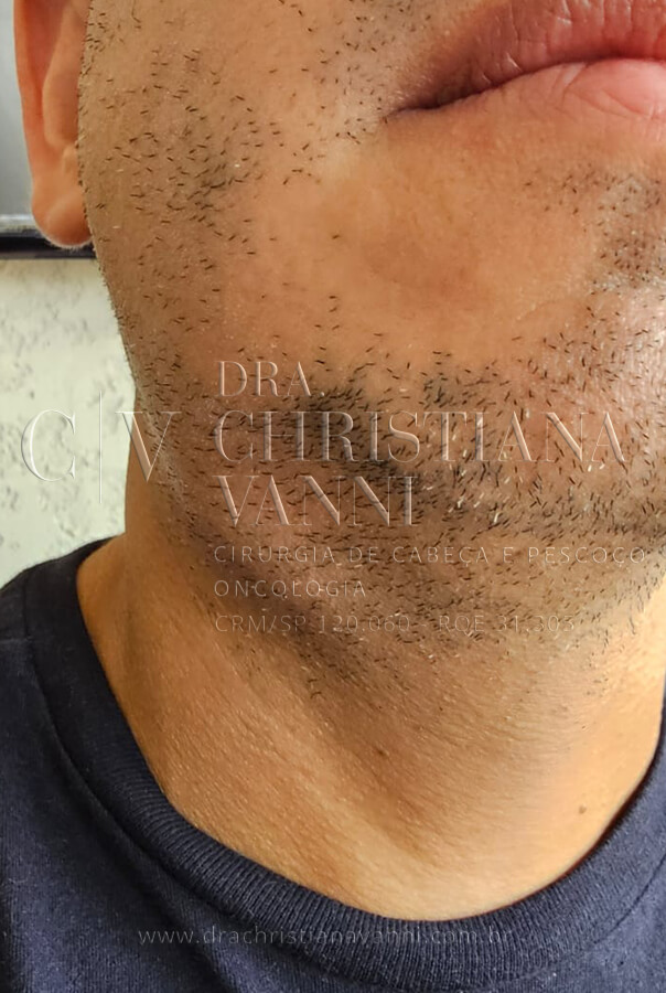 Infecção de glândula submandibular por cálculo