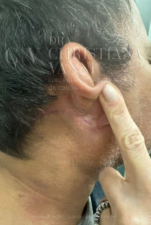 Cicatriz de Cirurgia de Parótida com acesso retroauricular