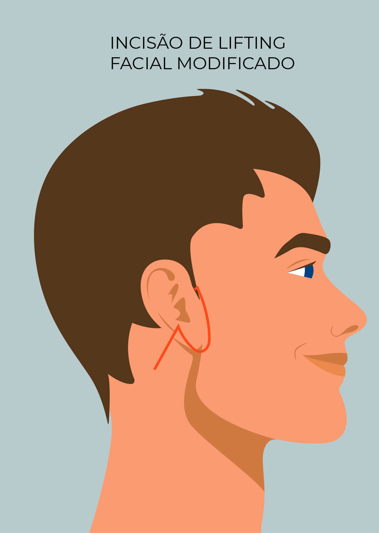 Tipos de Incisões