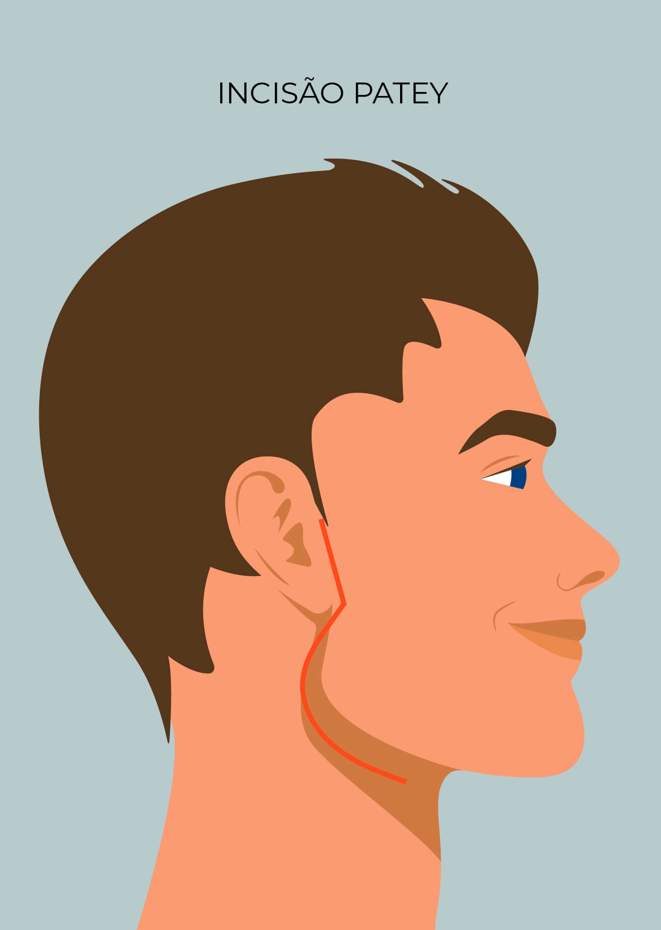 Tipos de Incisões