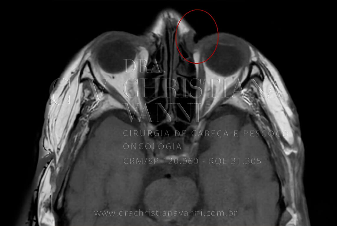 Ressonância magnética (tumor ocular)