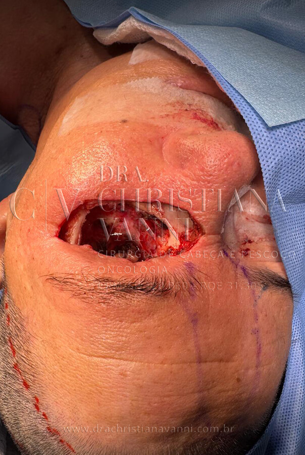 Foto de cirurgia de retirada do olho (exenteração orbitária)