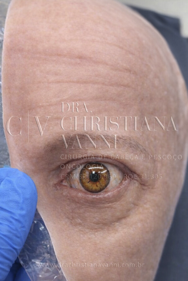 Tipos de prótese ocular