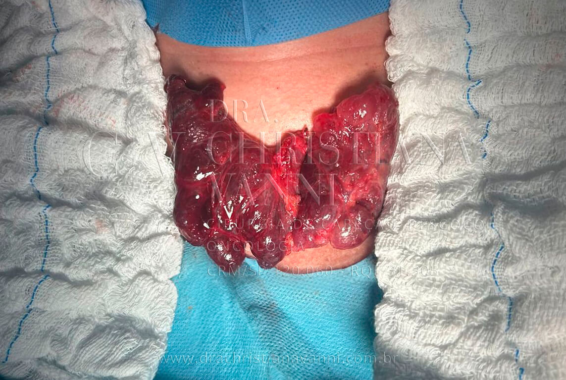 glândula tireoide