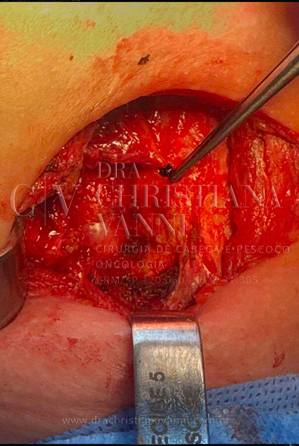Cirurgia de Tireoide
