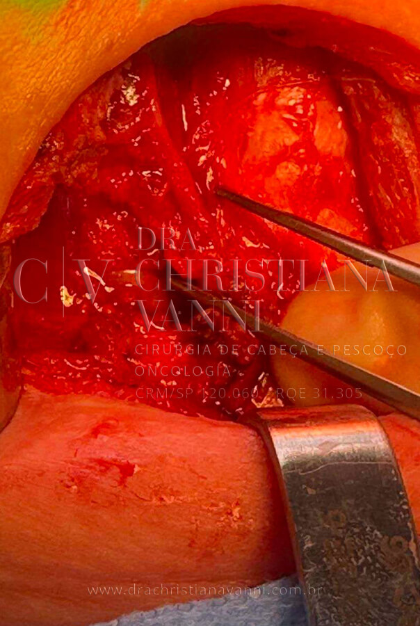 Cirurgia de Tireoide
