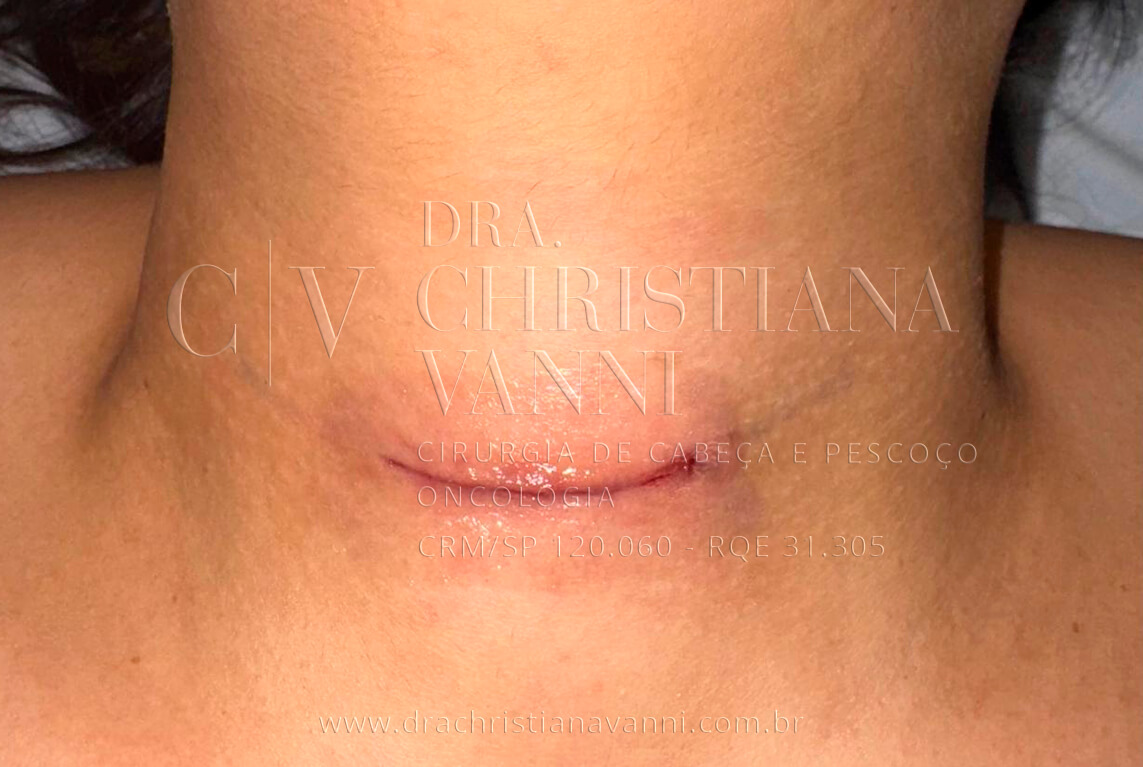Cicatriz Pós Cirurgia de Tireóide