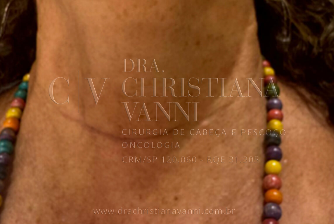 Cicatriz Pós Cirurgia de Tireóide