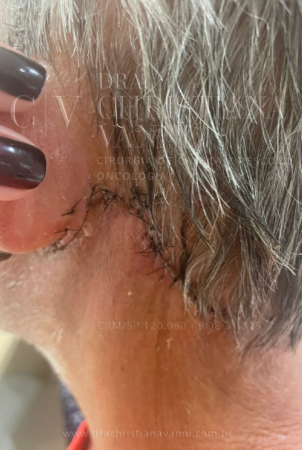 Cirurgia corretiva com acesso retroauricular