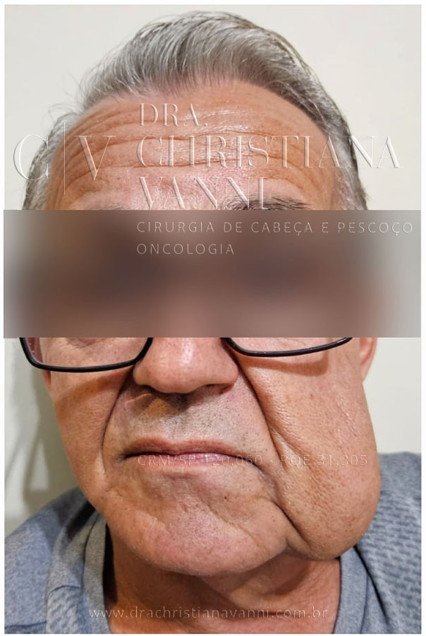 Malformação Arteriovenosa (antes da cirurgia corretiva)