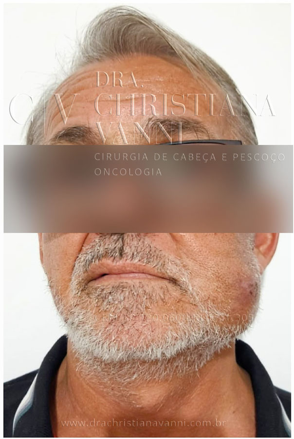Malformação Arteriovenosa (depois da cirurgia corretiva)