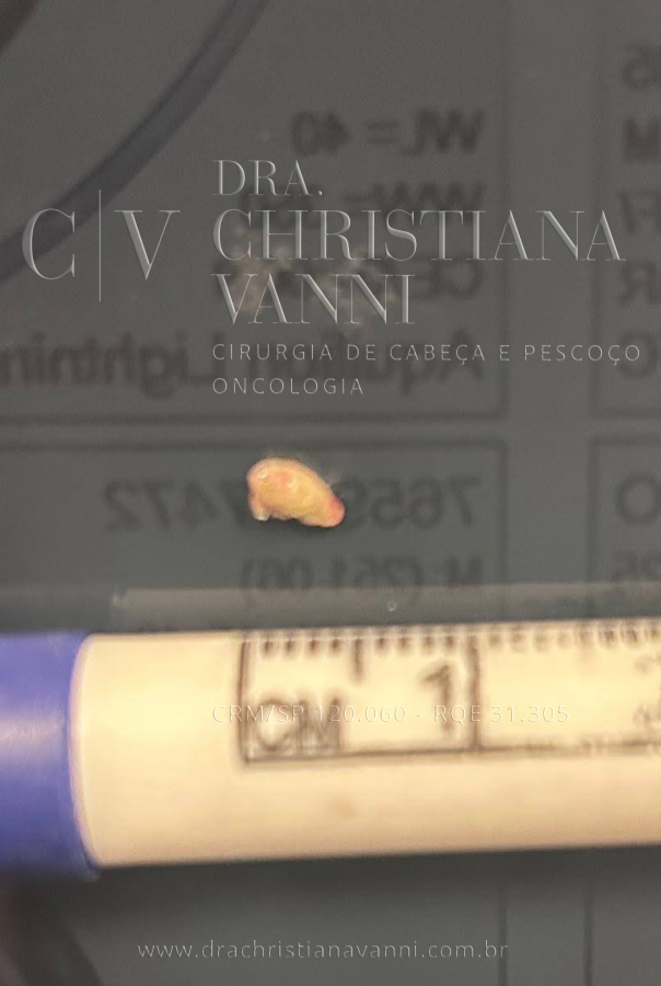 Cálculo salivar de 0,5cm
