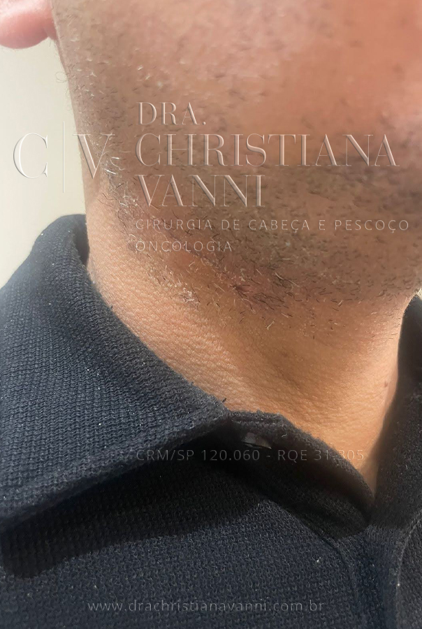 Técnica de cicatriz escondida em prega do pescoço (7 dias após cirurgia)