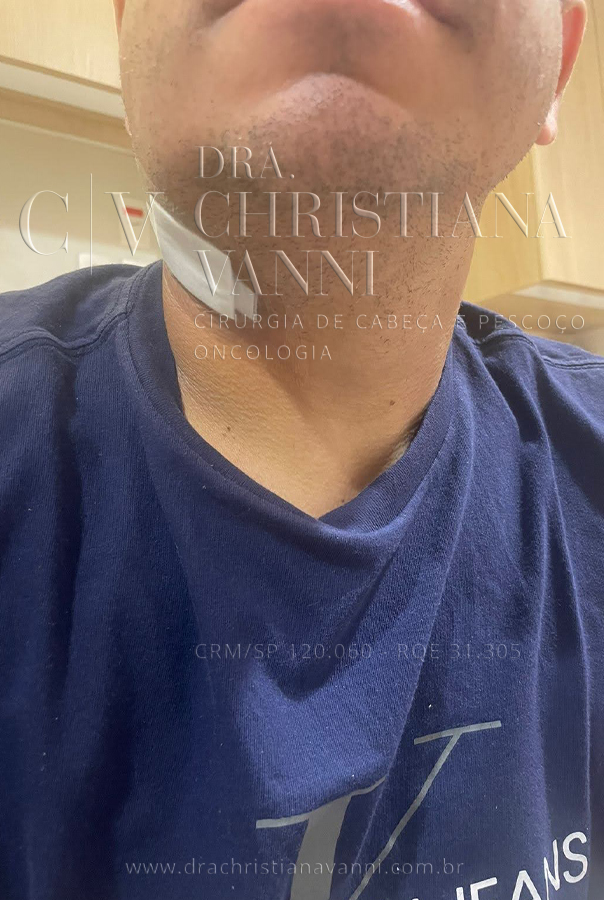 Pós cirúrgico de ressecção de glândula submandibular (via convencional)