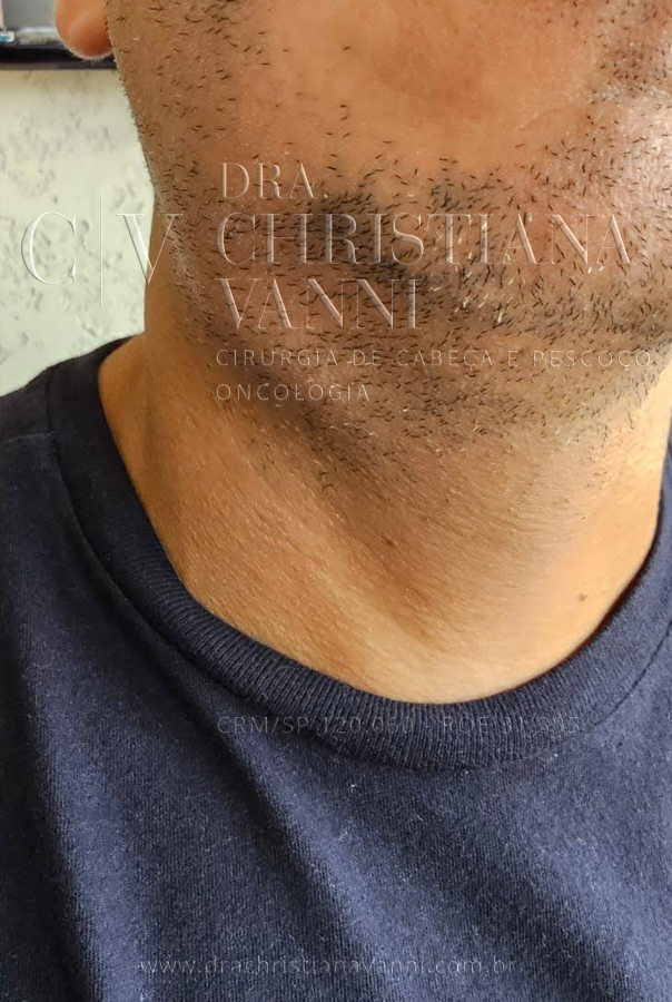 Inchaço - sintoma de inflamação da glândula salivar