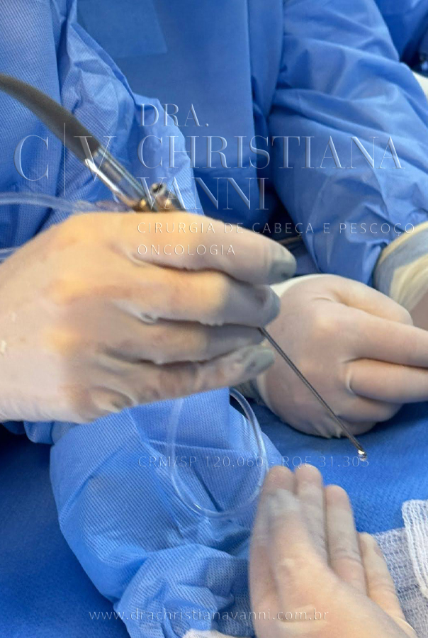 Sialoendoscopia