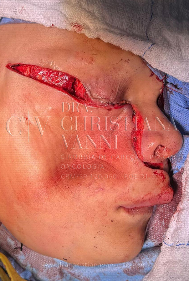 Cirurgia de sarcoma no rosto