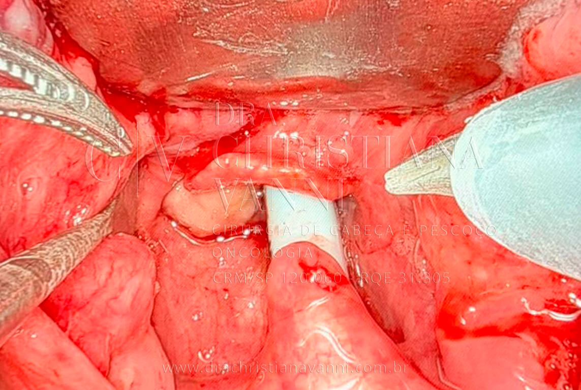 Cirurgia Robótica de Sarcoma