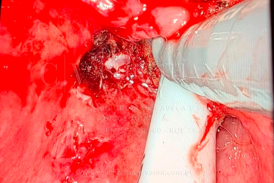 Cirurgia Robótica de Sarcoma