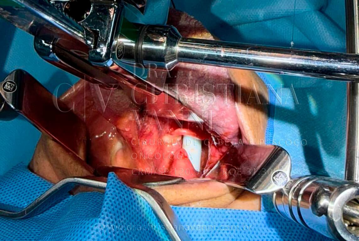 Cirurgia Robótica de Sarcoma