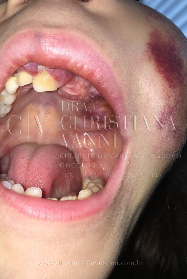 Foto de Sarcoma