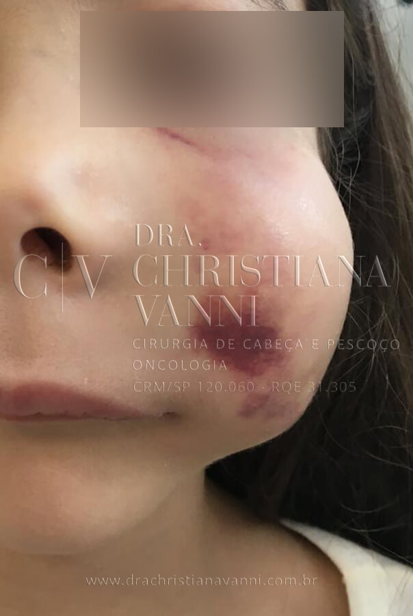 Foto de Sarcoma
