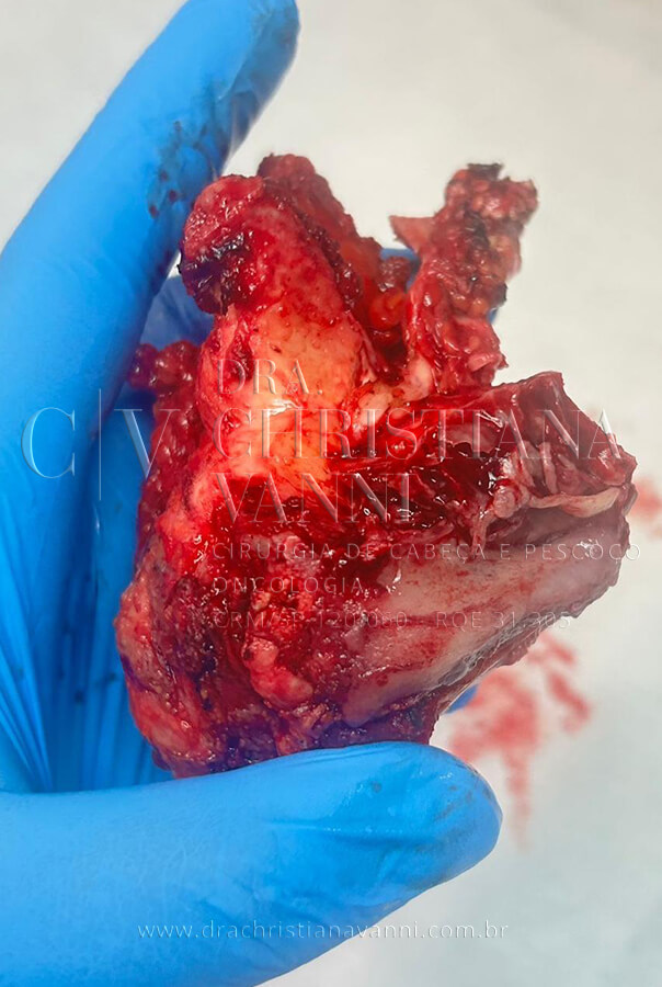 Foto de sarcoma após extirpação cirúrgica