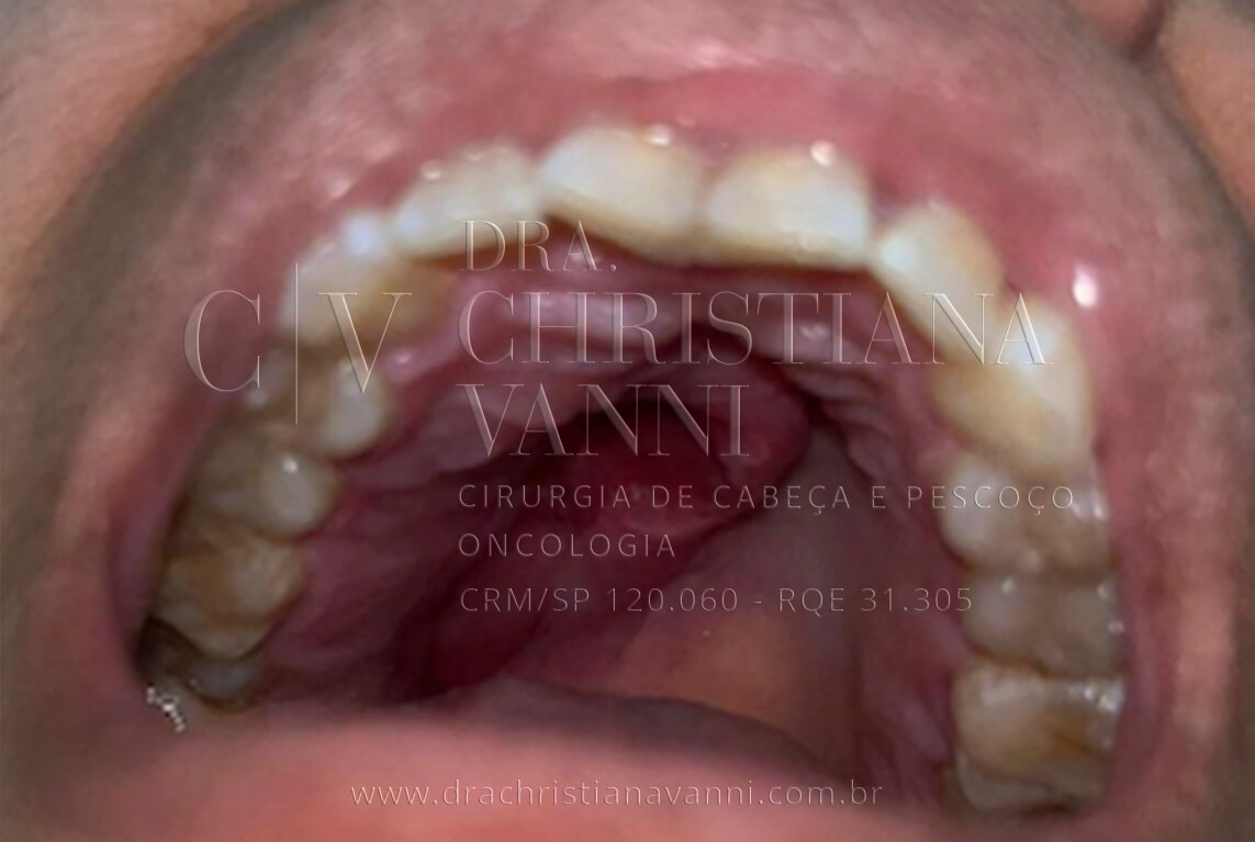 Foto de sarcoma no palato e nasofaringe