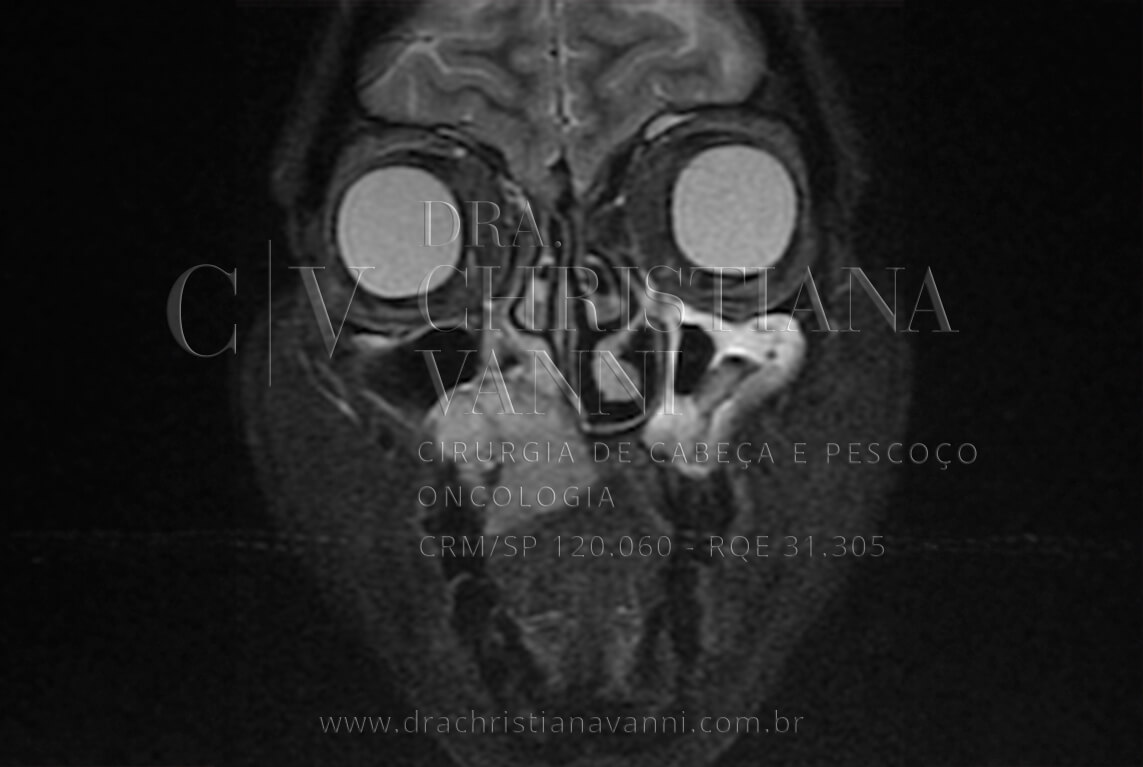 Foto de sarcoma no palato e nasofaringe