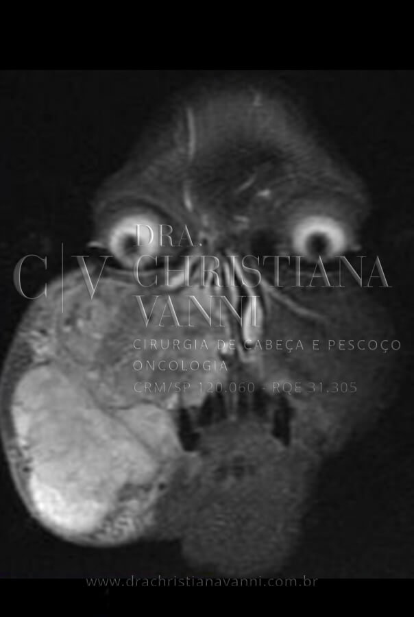 RNM de Sarcoma