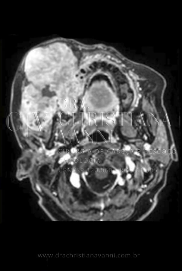 Tomografia de Sarcoma