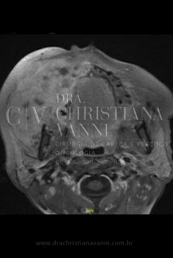 Tomografia de Sarcoma