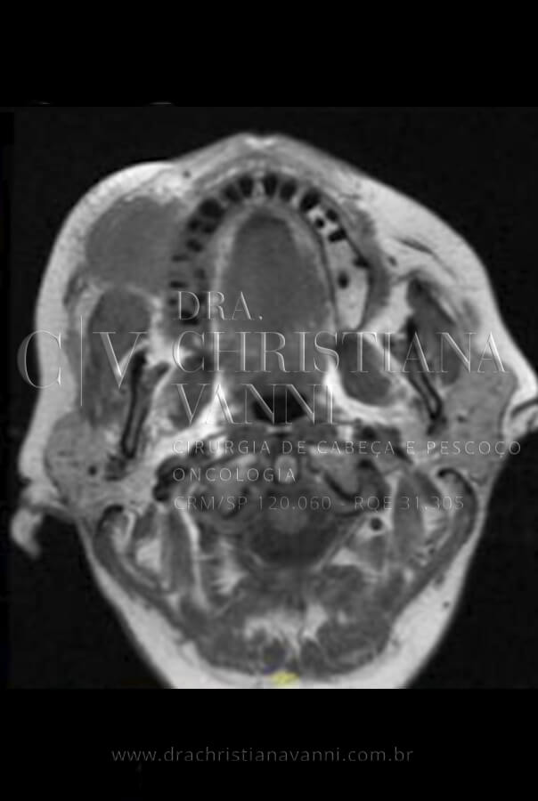 Tomografia de Sarcoma