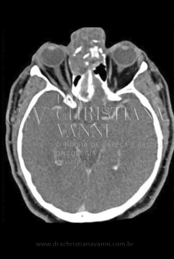 Tomografia de Sarcoma com Envolvimento Cervical
