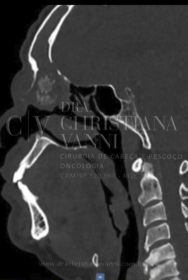 Tomografia de Sarcoma com Envolvimento Cervical
