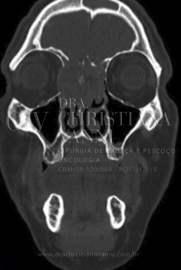 Tomografia de Sarcoma com Envolvimento Cervical