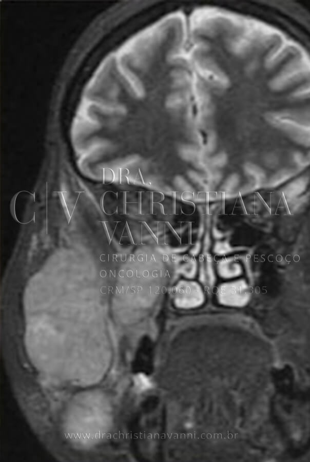Tomografia de Sarcoma na face