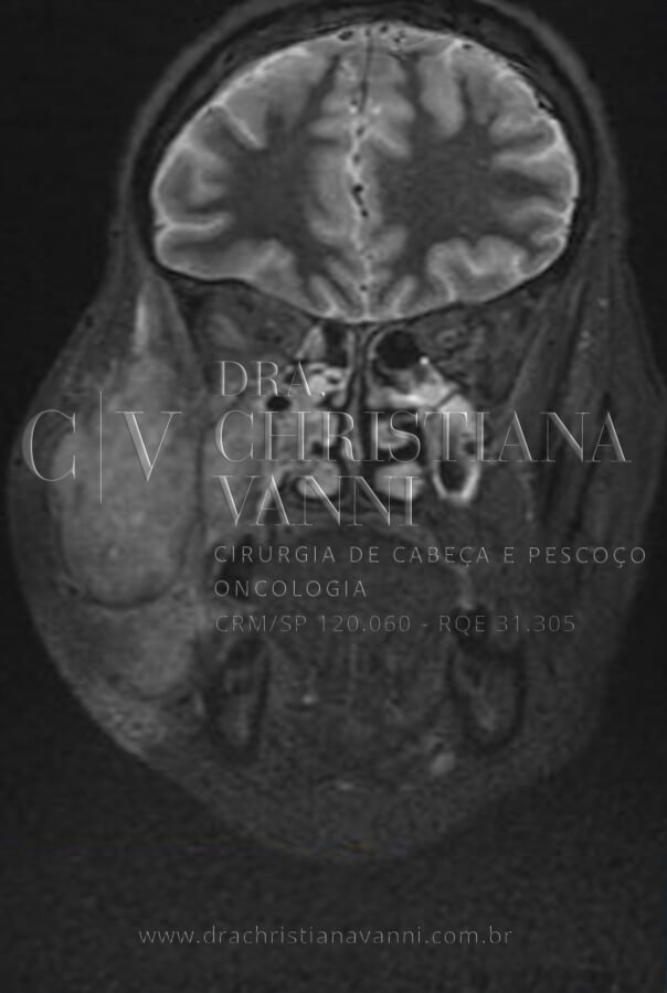 Tomografia de Sarcoma na face