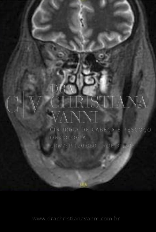 Tomografia de Sarcoma na face