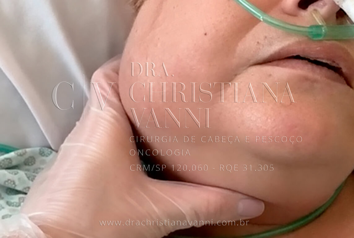 Glândula salivar inflamada