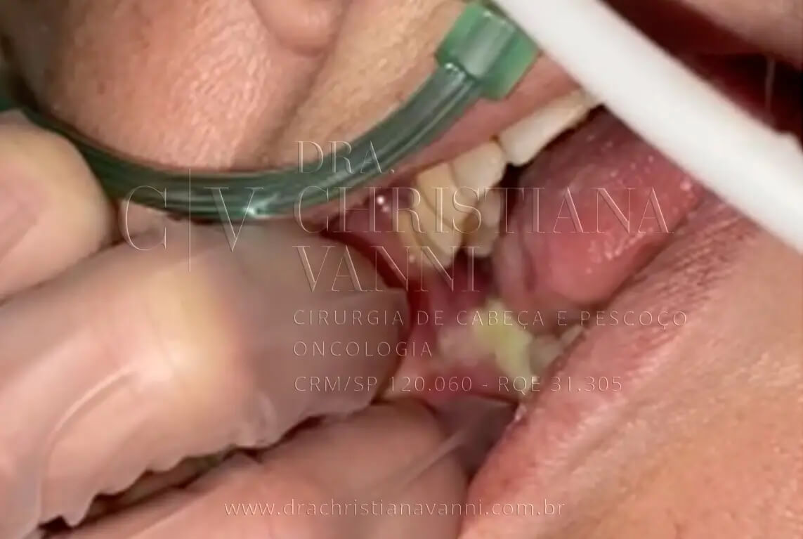 Glândula salivar inflamada (pus)