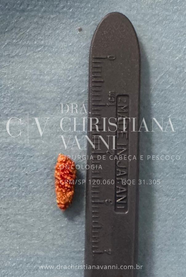 Cálculo salivar extraído por sialoendoscopia