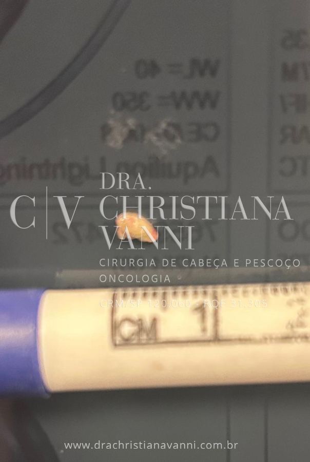 Cálculo salivar extraído