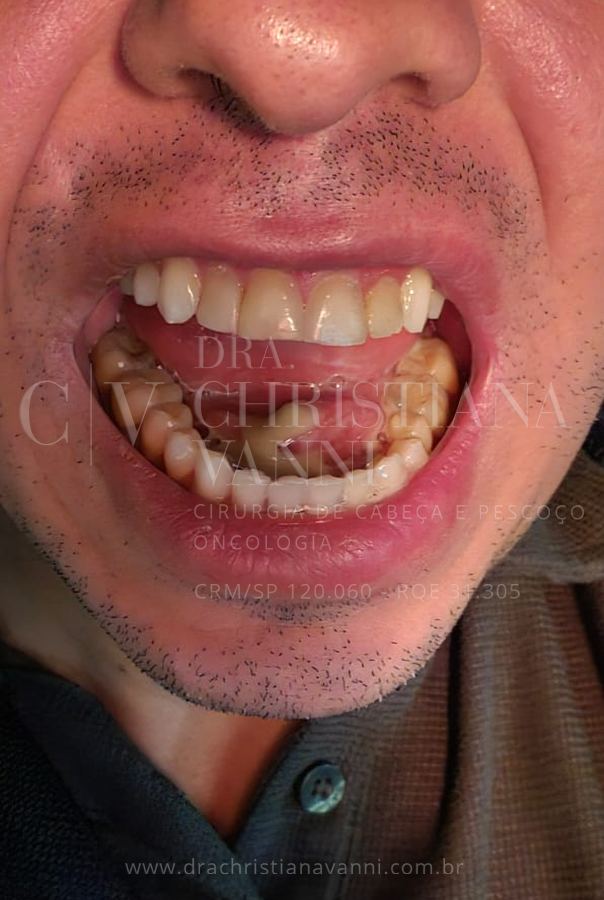 Inflamação e infecção de glândula salivar por cálculo obstrutivo