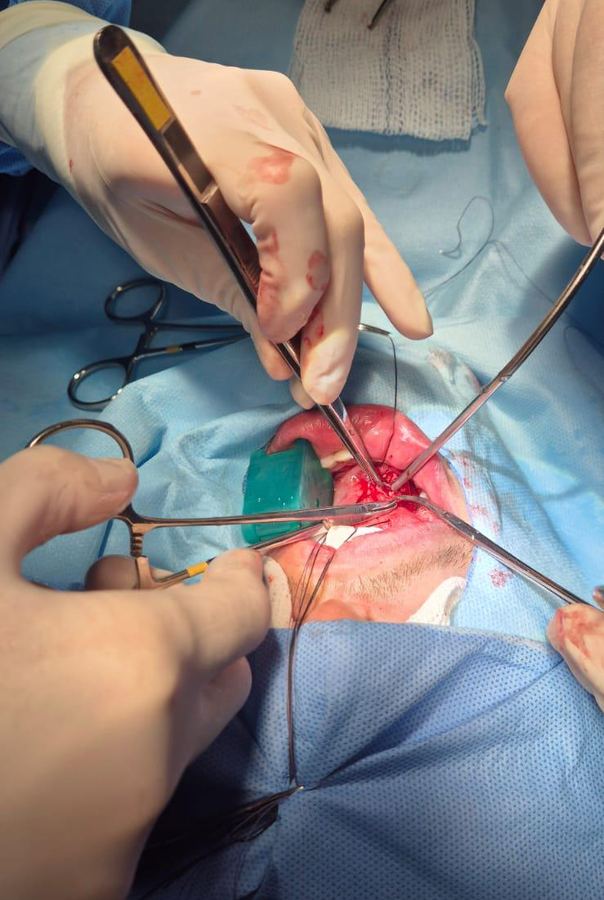 Dra. Christiana Vanni em Sialoendoscopia