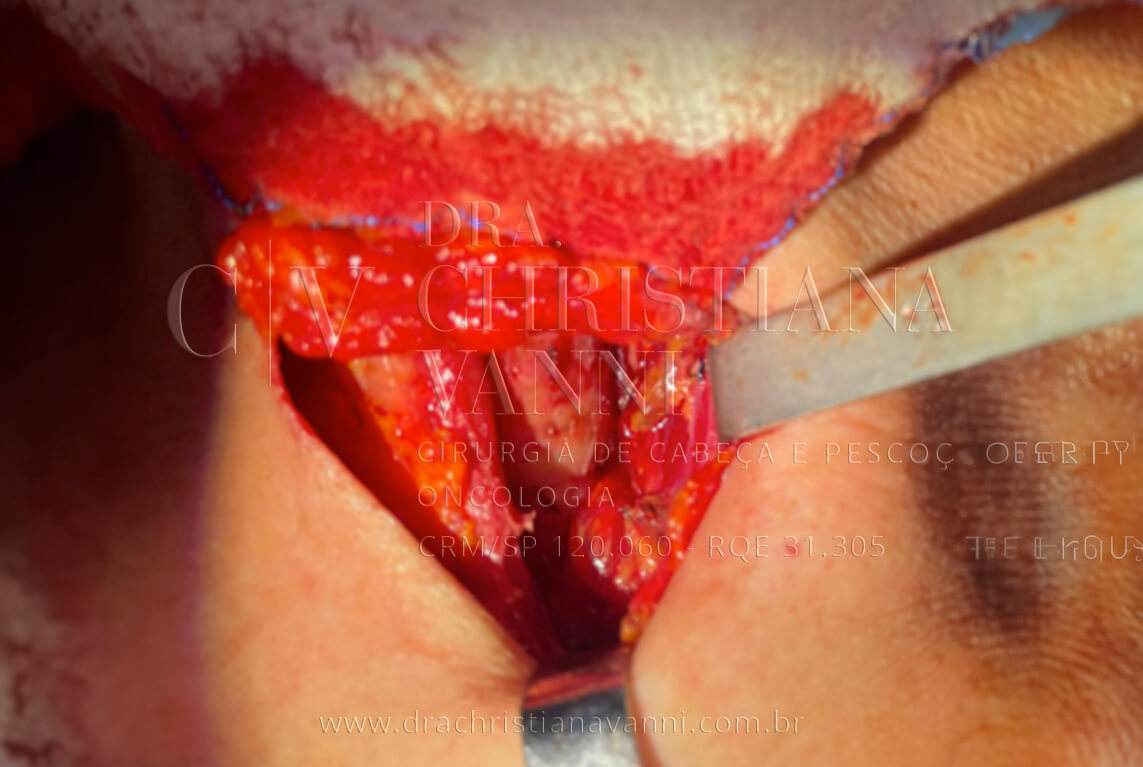 Cirurgia convencional de tireoide (muito vermelha - remover saturação)