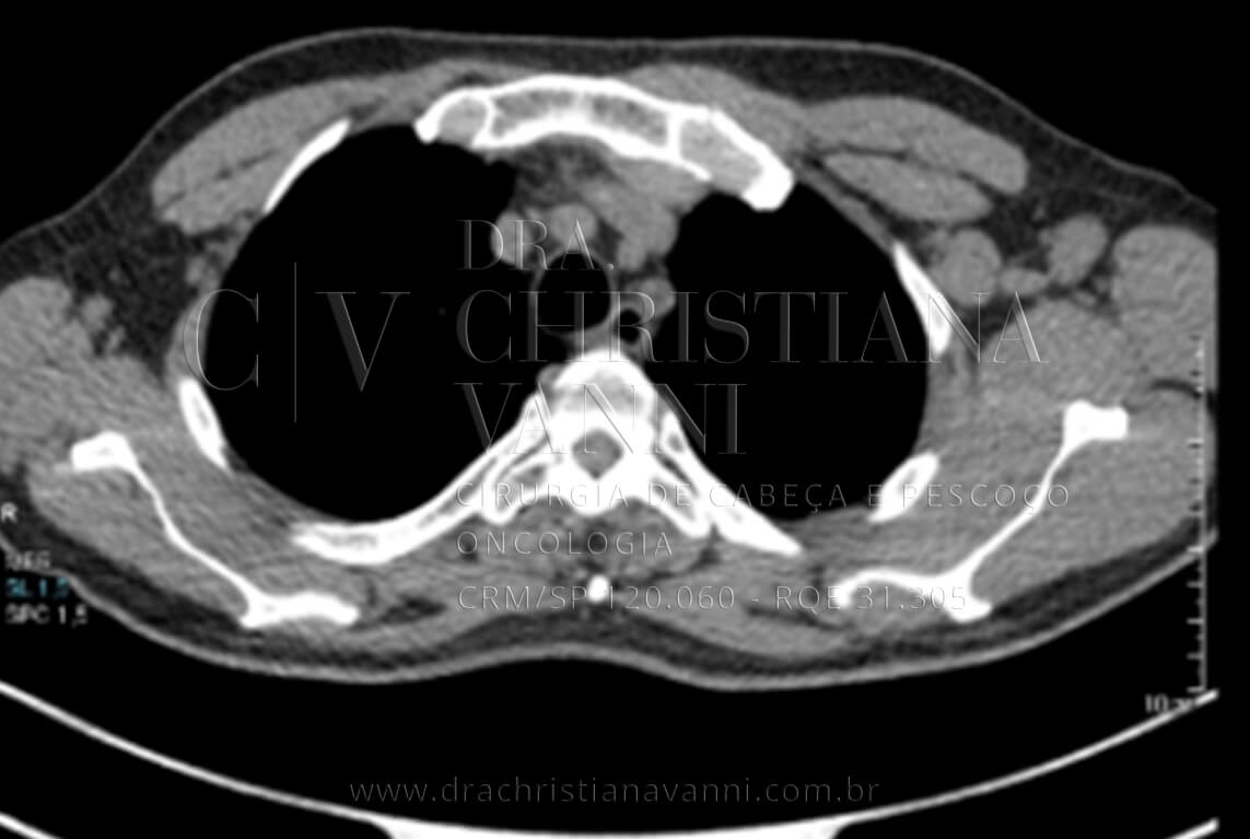 Exame PET-scan