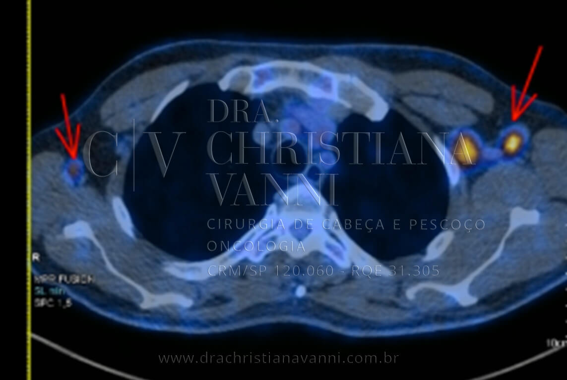 Exame PET-scan